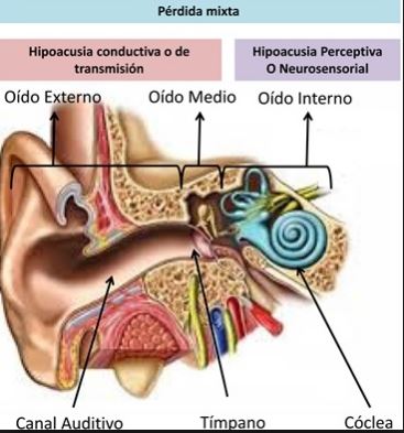 causas de la perdida auditiva