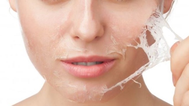 los peeling quimicos como tratamiento facial no invasivo