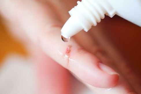 limpiar la herida y desinfectarla correctamente son vitales para curar una herida y evitar una cicatriz mas grande