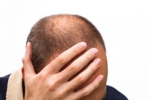 la alopecia areata