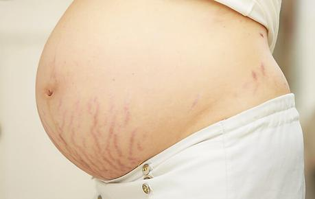 causas y prevencion de las estrias en el embarazo